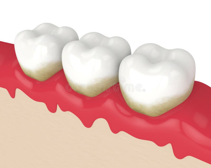 3d render of teeth in bleeding gums over white background. Periodontal disease concept. 3d render of teeth in bleeding gums over white background. Periodontal disease concept