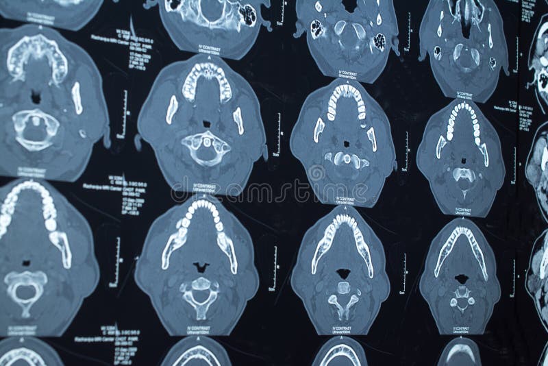 Research in medicine. CT scan of the patient. royalty free stock photography