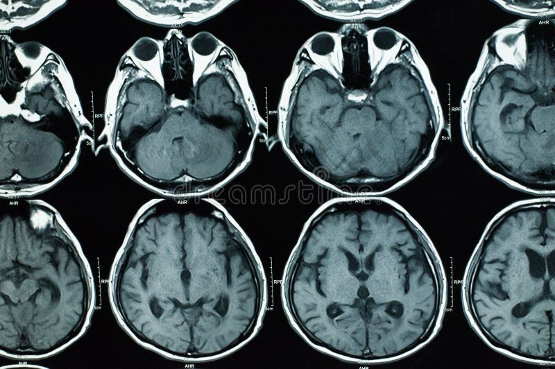 Research in medicine. CT scan of the patient. stock image