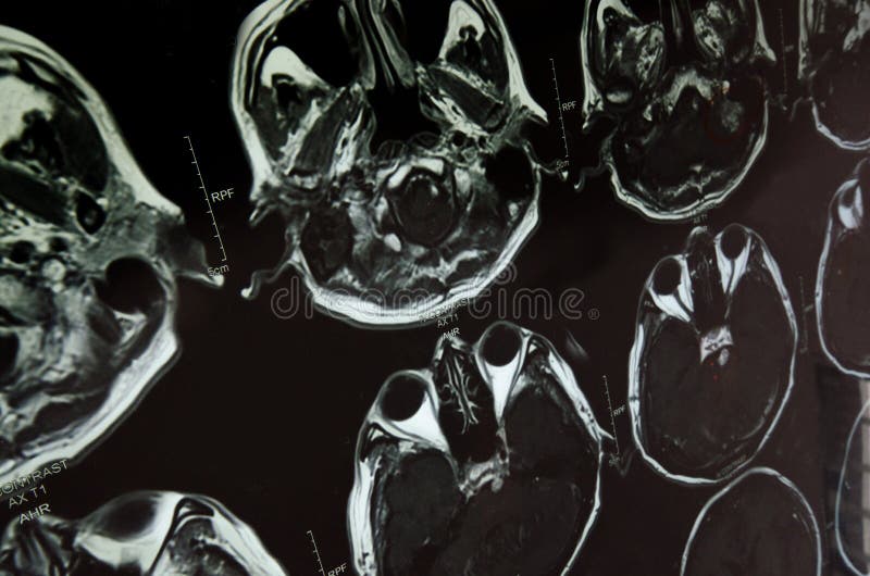 Research in medicine. CT scan of the patient. royalty free stock image