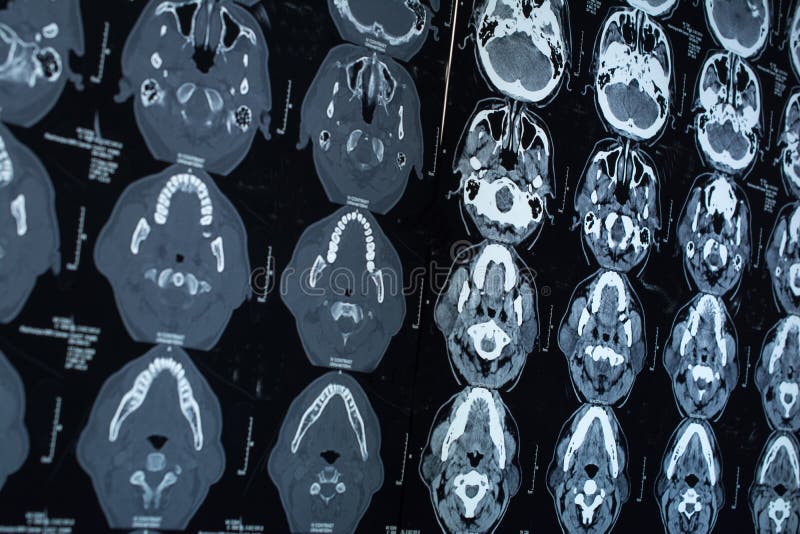 Research in medicine. CT scan of the patient. royalty free stock image