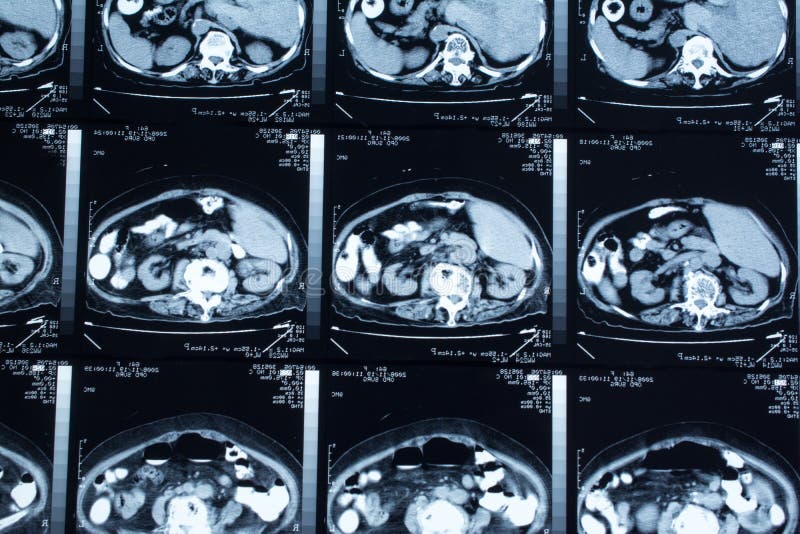 Research in medicine. CT scan of the patient. royalty free stock images