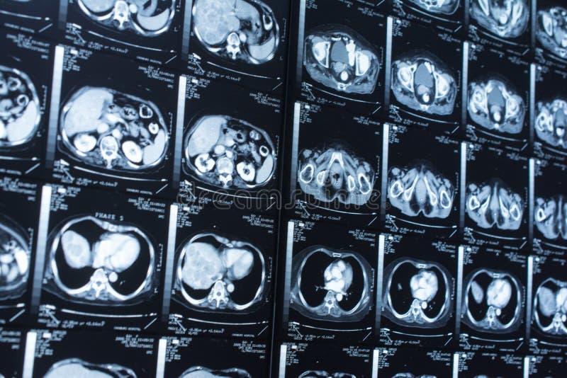 Research in medicine. CT scan of the patient. royalty free stock photo