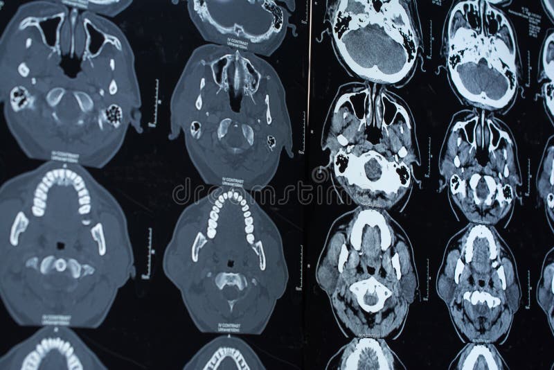 Research in medicine. CT scan of the patient. stock image
