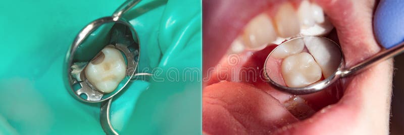 Restauration du plan rapproché de dent Le concept du trea esthétique photographie stock libre de droits Restauration du plan rapproché de dent Le concept du trea esthétique photographie stock libre de droits