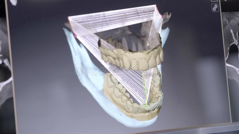 restauração dental da modelagem 3D digital modelo 3d dos dentes, dentes feitos a varredura do paciente O doutor é estudar