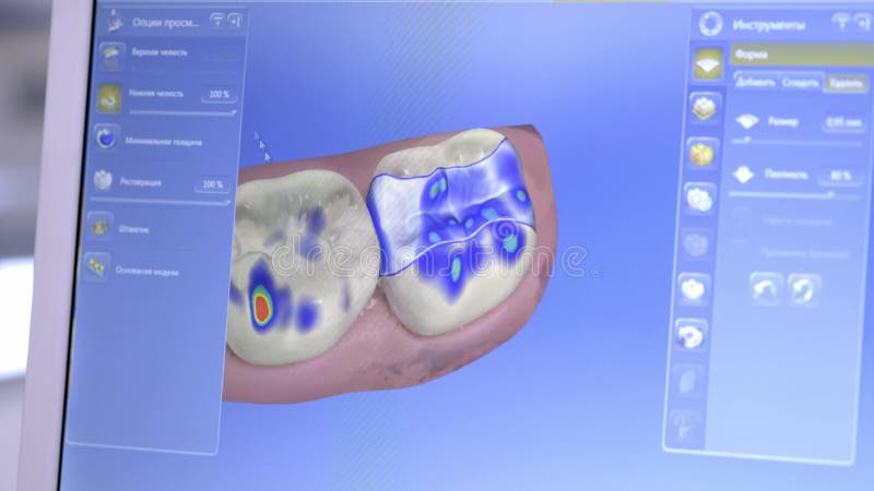 restauração dental da modelagem 3D digital modelo 3d dos dentes, dentes feitos a varredura do paciente O doutor é estudar