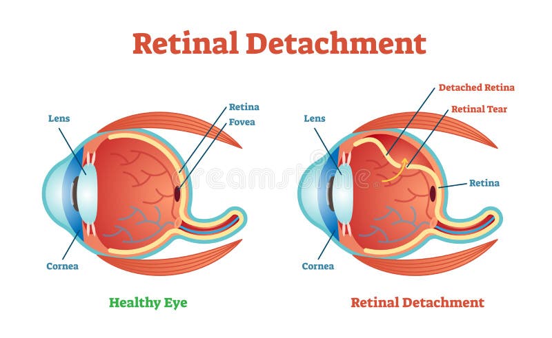 Retinal Detachment vector illustration diagram, anatomical scheme.