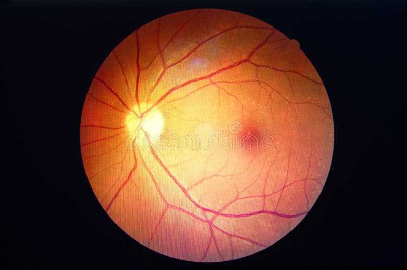 Retinopatia del diabete fotografie stock Retinopatia del diabete fotografie stock