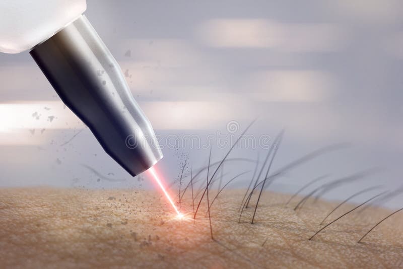 Retiro del pelo del laser del procedimiento de la cosmetología en las partes del cuerpo Ep del laser fotografía de archivo Retiro del pelo del laser del procedimiento de la cosmetología en las partes del cuerpo Ep del laser fotografía de archivo