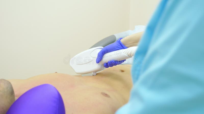 Retiro masculino del pelo del laser un doctor en guantes quita el pelo del abdomen y de los pechos de un hombre Primer fotos de archivo libres de regalías Retiro masculino del pelo del laser un doctor en guantes quita el pelo del abdomen y de los pechos de un hombre Primer fotos de archivo libres de regalías