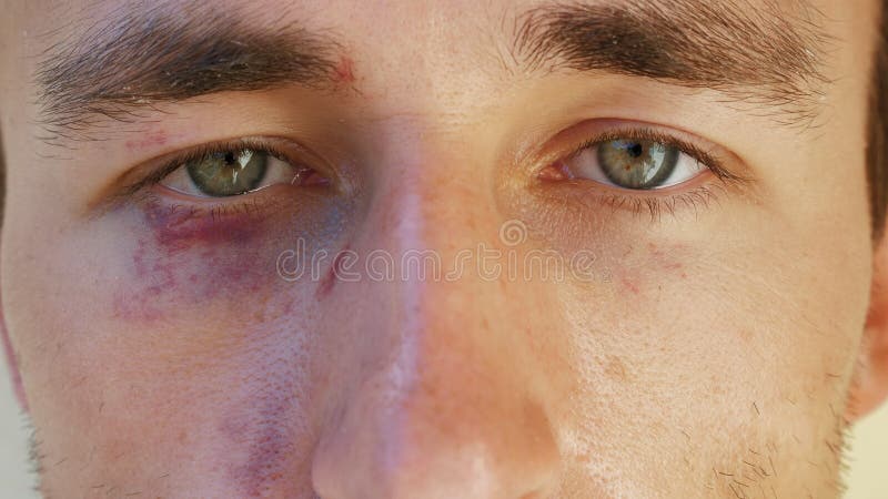 Retrato de um homem europeu com hematomas sob os olhos