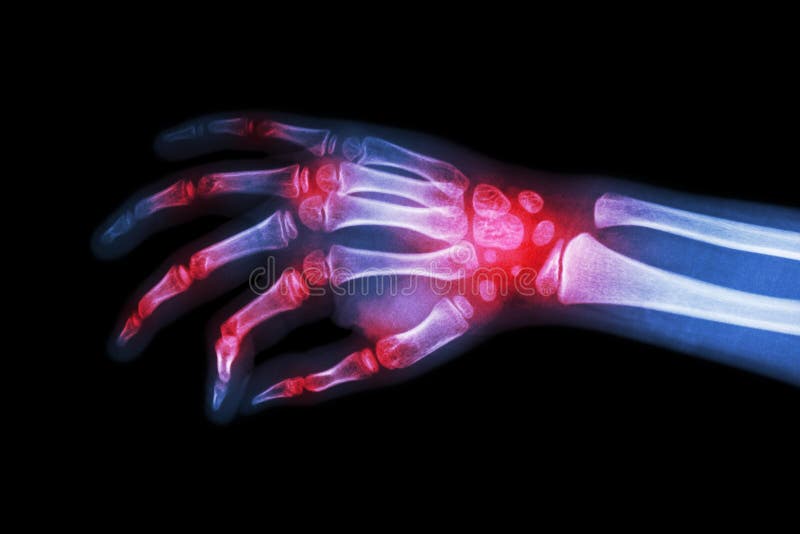 Reumatoïde artritis, Jichtige artritis (Film x-ray hand van kind met artritis bij veelvoudige verbinding)