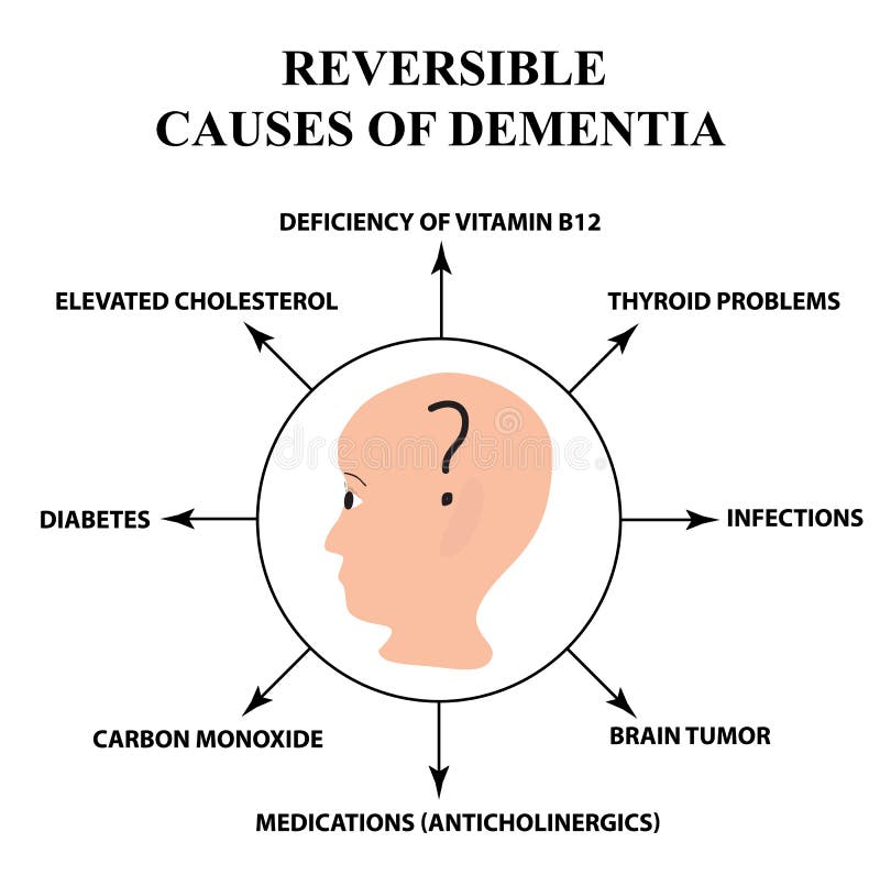 Reversible causes of senile dementia. Alzheimer`s disease. Infographics. Vector illustration on isolated background