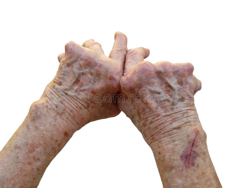 Rheumatoid Arthritis royalty free stock photography Rheumatoid Arthritis royalty free stock photography