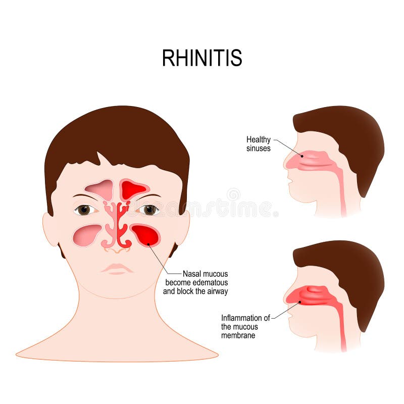 Rhinitis Coryza. Healthy Sinuses and Sinuses with Inflammation
