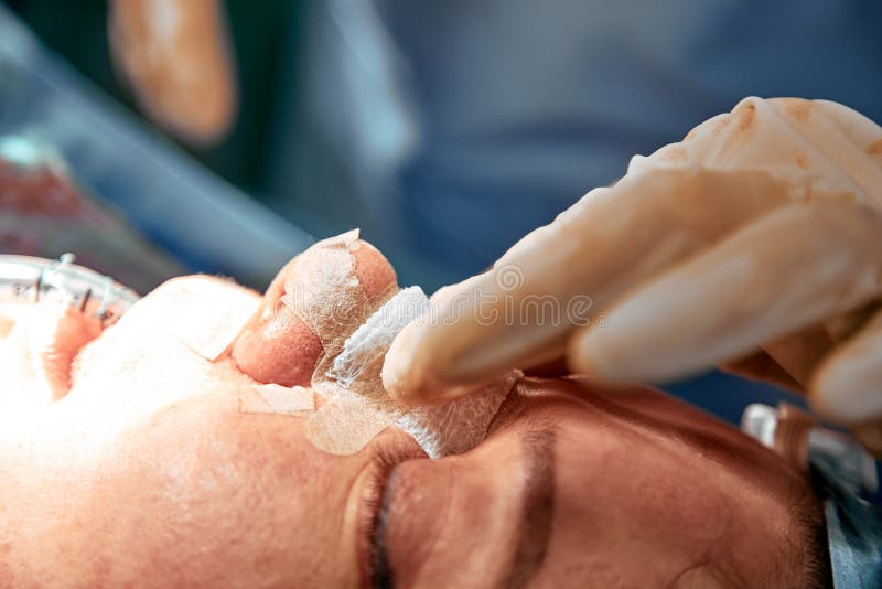 Rhinoplasty close-up. An operating team of several doctors performs nose surgery. Curved septum, breathing problems stock images Rhinoplasty close-up. An operating team of several doctors performs nose surgery. Curved septum, breathing problems stock images