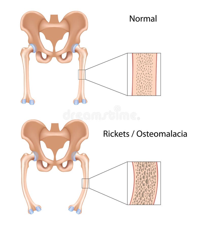 Rickets and Osteomalacia