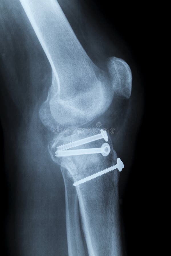 Ricostruzione di un ginocchio umano di destra dopo l'arresto