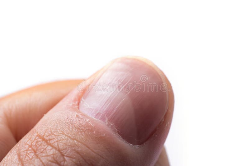 Vertical Ridges Nails Stock Photos - Free & Royalty-Free Stock Photos from Dreamstime Vertical Ridges Nails Stock Photos - Free & Royalty-Free Stock Photos from Dreamstime