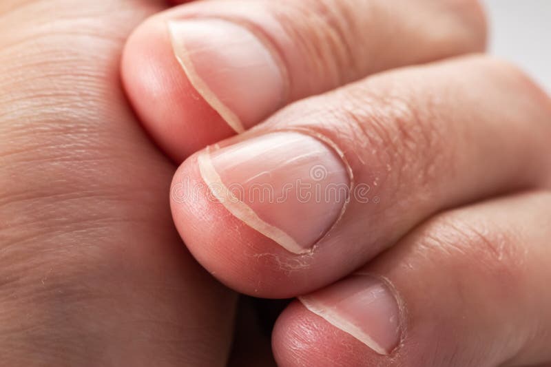 ridged fingernails vertical ridges nails problems 285698607