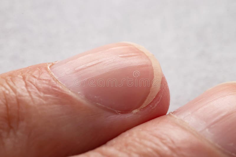 Premium Photo  White spots on finger nails called leukonychia reveal the  emergence of health problems