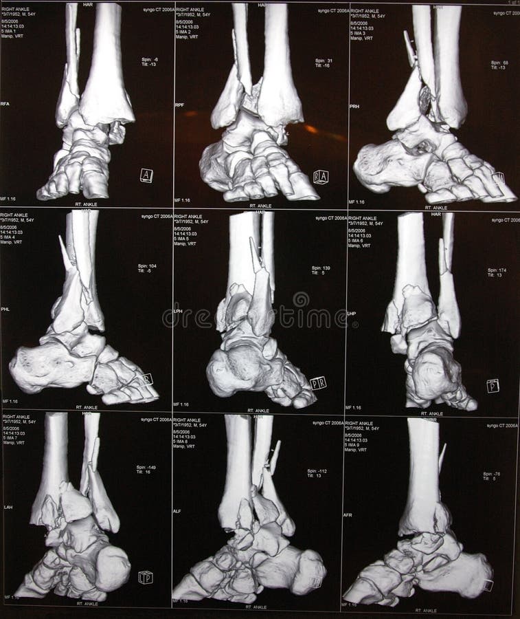 Immagine di caviglia destra CT.