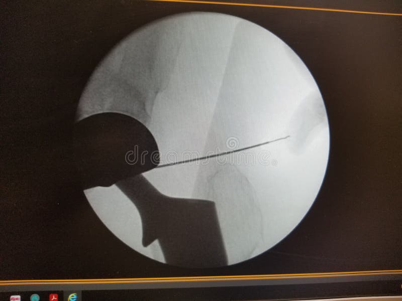Right Prosthetic Hip Xray with Angiography Catheter Stock Image