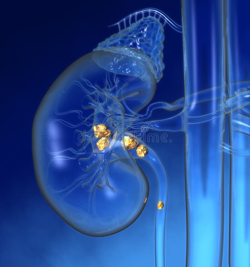 Illustration showing human kidney with highlighted kidney stones and stone in ureter. Colorful medically 3D illustration. Illustration showing human kidney with highlighted kidney stones and stone in ureter. Colorful medically 3D illustration