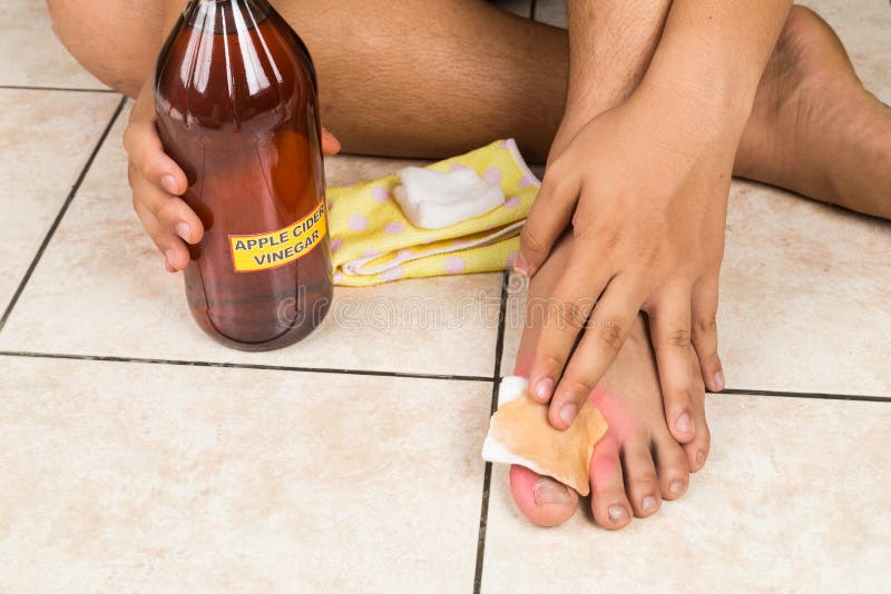 Rimedio naturale dell'all'aceto di sidro di Apple efficace al prurito della pelle, fung fotografia stock Rimedio naturale dell'all'aceto di sidro di Apple efficace al prurito della pelle, fung fotografia stock