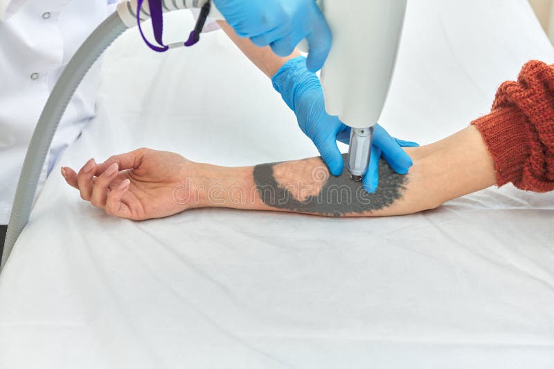 Rimozione del tatuaggio laser sul braccio femminile