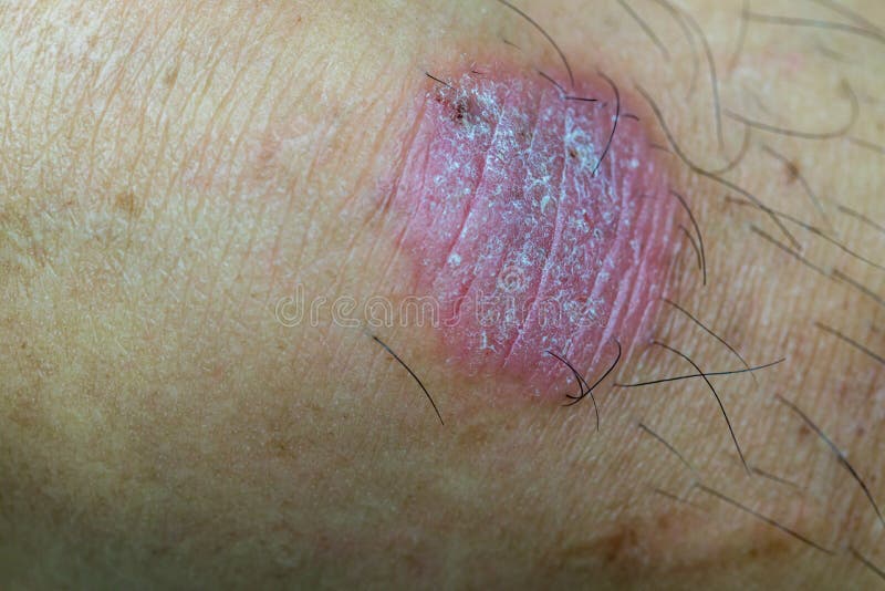 Ring Worm Infection, Dermatophytosis on Skin. Ringworm Infection
