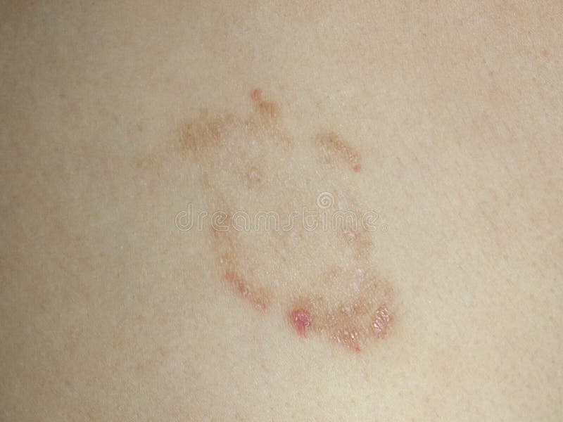 Symptoms of ringworm