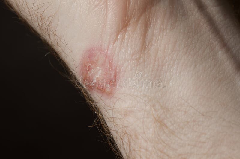 Ringworm на белом человеке/Mycosis стоковые изображения rf Ringworm на белом человеке/Mycosis стоковые изображения rf