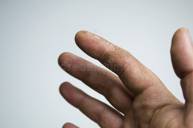 Risse Haut an Den Fingern Trockene Haut. Ihre Creme Hilft Diesen Händen.  Vitaminmangel. Stockbild - Bild von obacht, aufgesprungen: 232853903