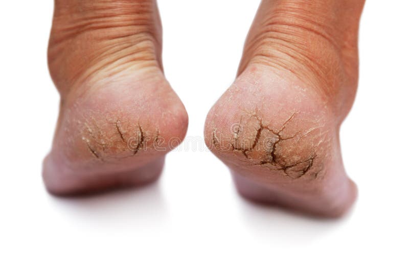 Chapped heel on a white background. Chapped heel on a white background