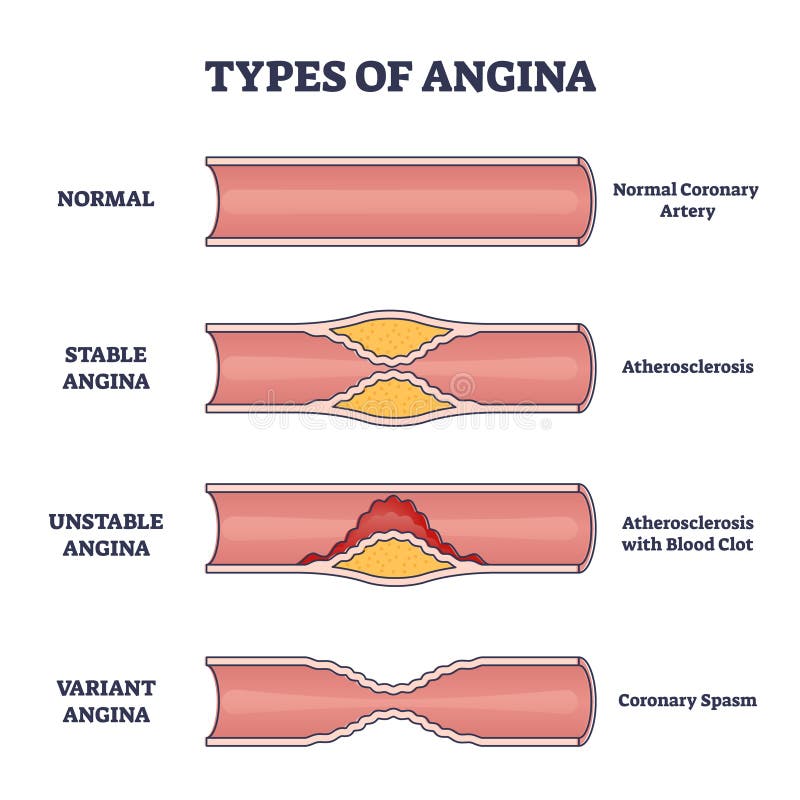 Types of angina as chest pain and heart problem explanation outline diagram. Educational anatomical normal, stable and unstable illness comparison with inner artery disease example vector illustration. Types of angina as chest pain and heart problem explanation outline diagram. Educational anatomical normal, stable and unstable illness comparison with inner artery disease example vector illustration