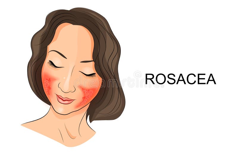 Rosacea na cara das meninas dermatology ilustração stock Rosacea na cara das meninas dermatology ilustração stock