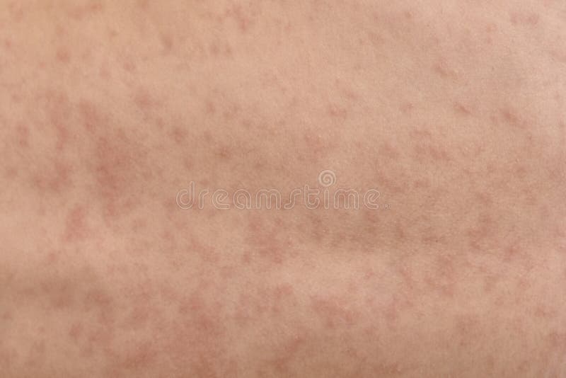 Roseola Rash a Viral Rash on the Skin of a Child Stock Photo Image of