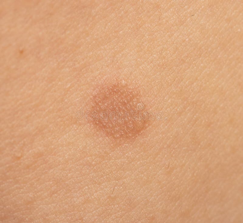 Round Skin Burns from Hot Oil Stock Image Image of skin, female