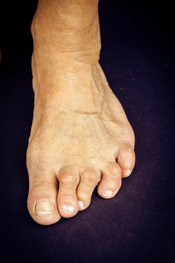 Rrheumatoid Arthritis Hand and Toe Deformities Stock Image Image of