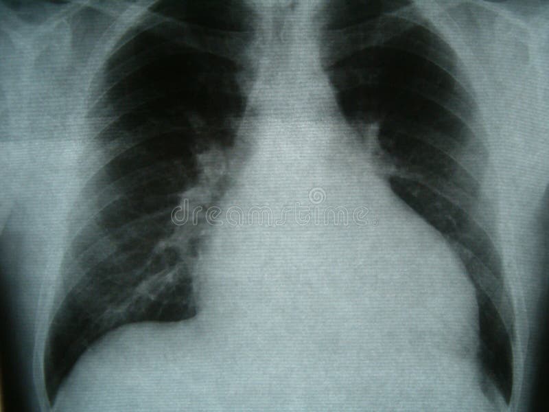 Röntgenbild bröstkorg, hjärtafel