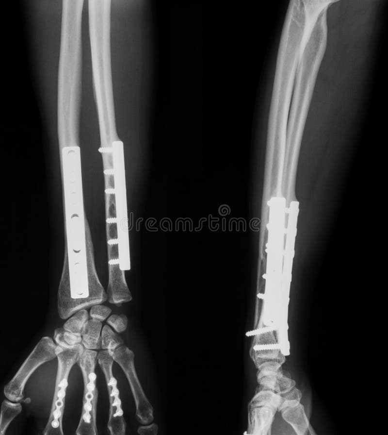 Röntgenbild Des Gebrochenen Unterarms Stockbild Bild von doktor