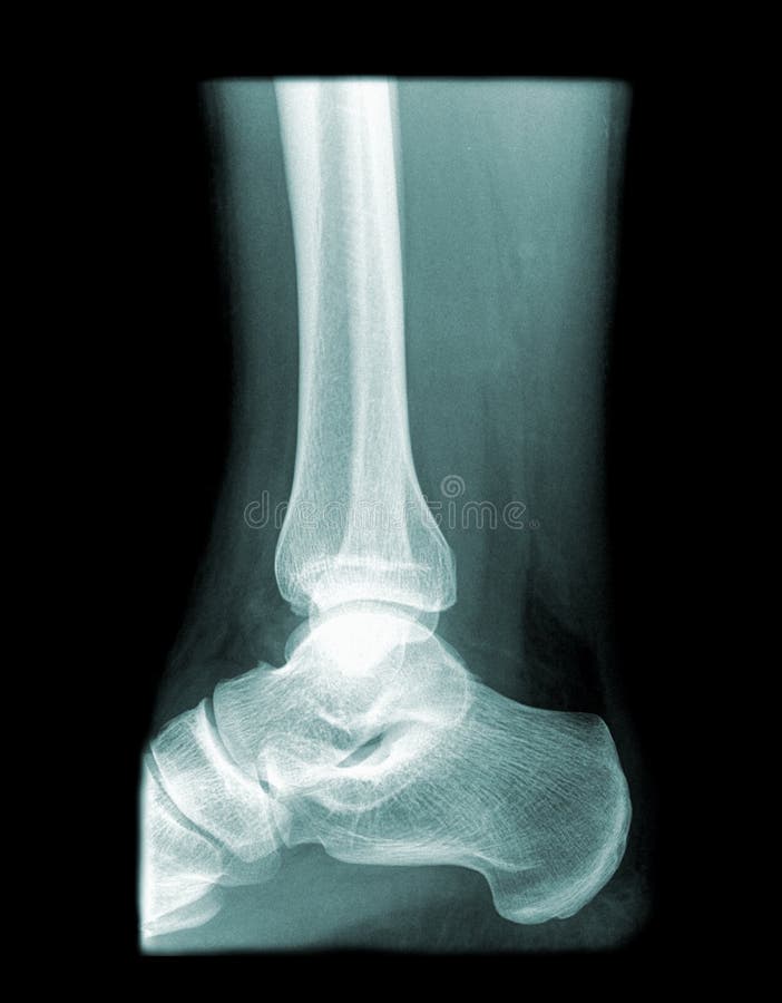 Image of a ankle seen from the side isolated on black background. Image of a ankle seen from the side isolated on black background