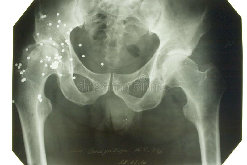 X-ray picture of the pelvis after gun shot. X-ray picture of the pelvis after gun shot