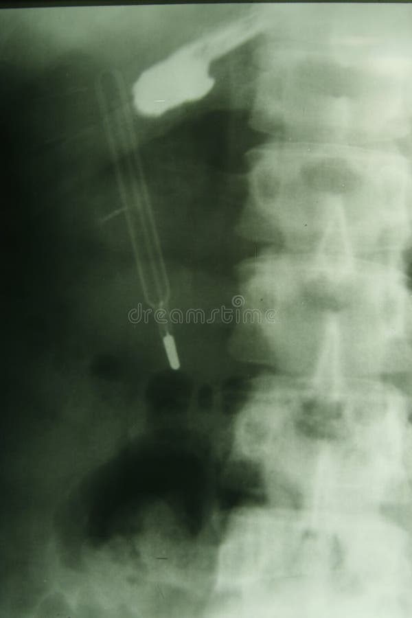 X-ray photo of a vertebra with a shade of thermometer visible on it. X-ray photo of a vertebra with a shade of thermometer visible on it