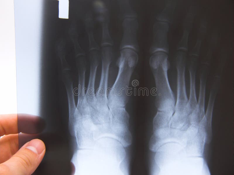 X-ray photo of a woman feets in hand. X-ray photo of a woman feets in hand