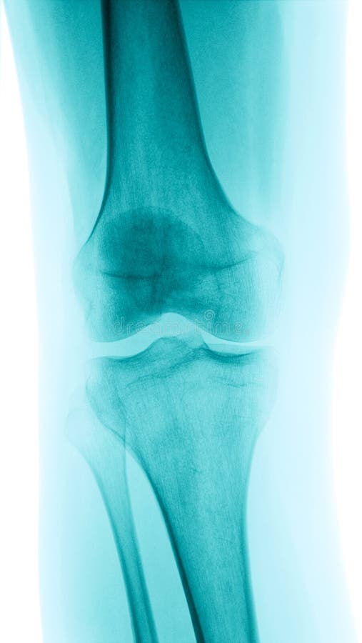 Detailed X-ray of a healthy human right knee. Image created using modern digital radiography. Detailed X-ray of a healthy human right knee. Image created using modern digital radiography