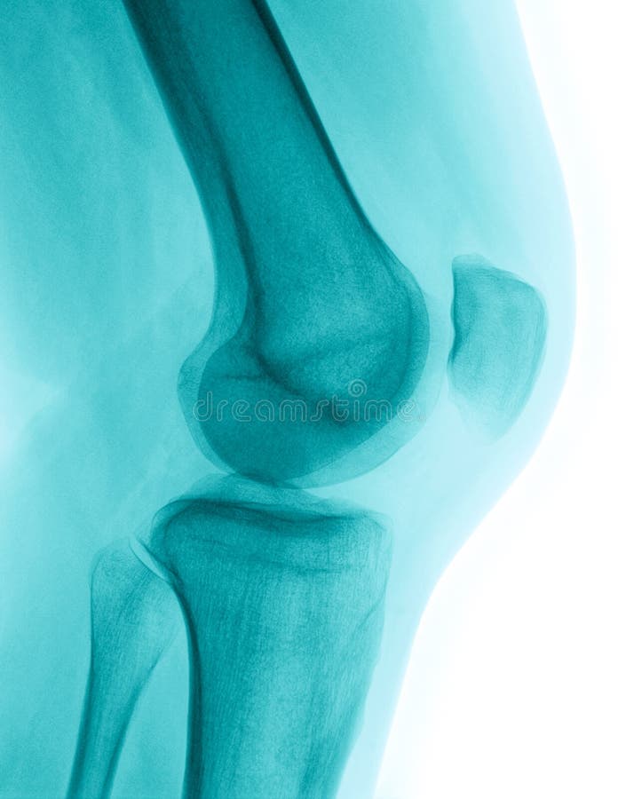 Detailed X-ray of a healthy human right knee. Image created using modern digital radiography. Detailed X-ray of a healthy human right knee. Image created using modern digital radiography