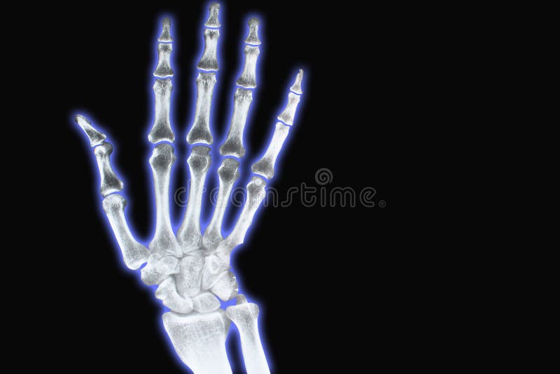 Hand x-ray with blue outer glow on a black background. Hand x-ray with blue outer glow on a black background